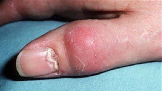 поражение ногтя при псориатическом артрите
