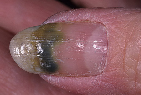 зеленые ногти - онихия псевдомоназная