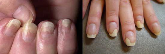 грибок ногтей на руках - онихолитический тип