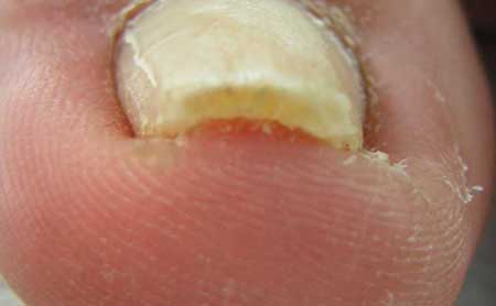 Фото грибка ногтя и стопы на начальном этапе