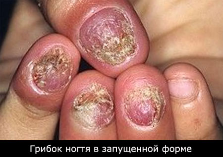 Лечение грибка ногтя запущенная форма
