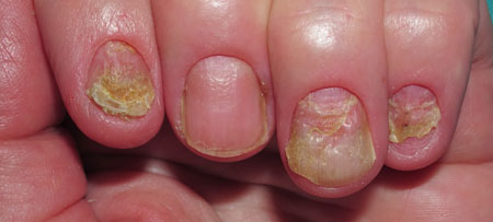 последствия запущенной формы грибкового поражения ногтей
