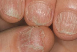 лечение грибка ногтя запущенной формы
