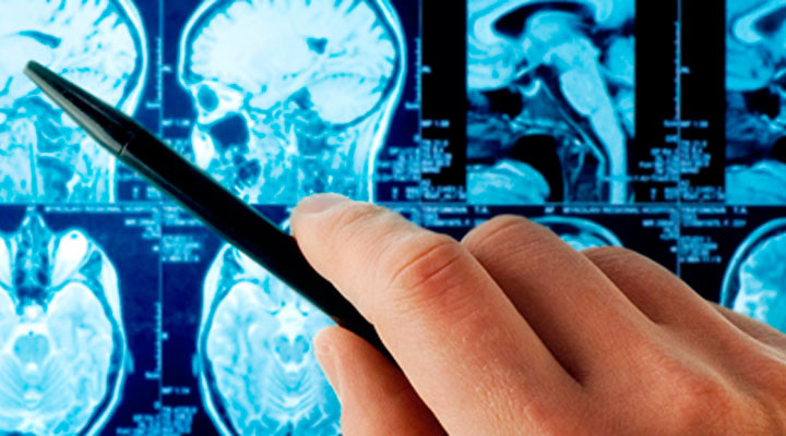 Виды инсультов головного мозга: признаки, диагностика, причины