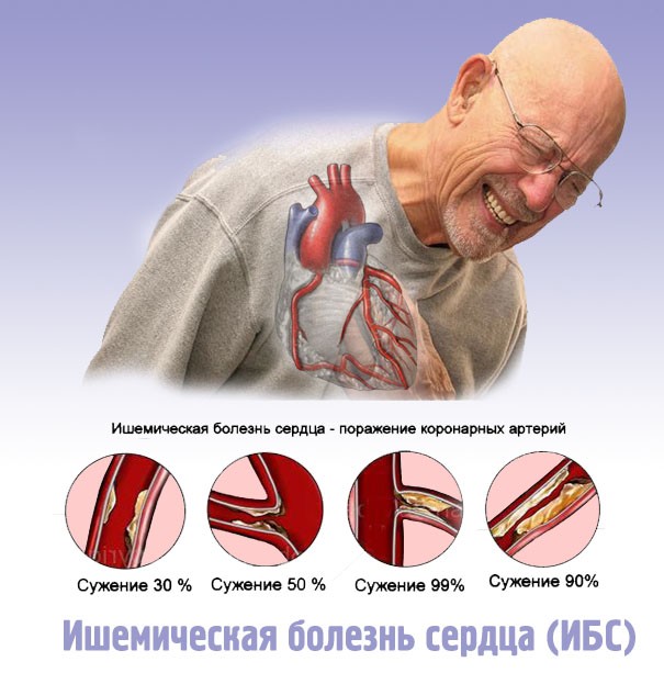 ibs-porazheniye-koronarnykh-arteriy