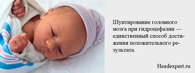 Шунтирование головного мозга очень эффективно при гидроцефалии новорожденных
