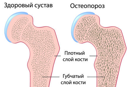Остеопороз тазобедренного сустава
