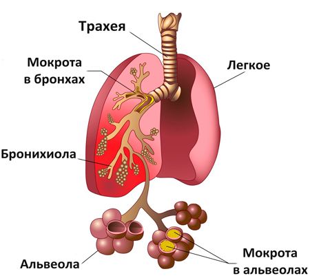 Пневмония как развитие бронхита