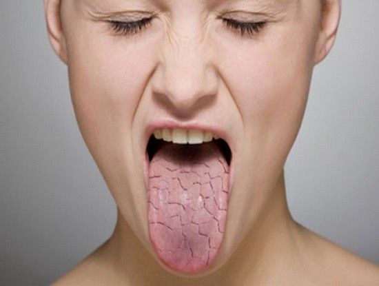 Одним из симптомов кандидозного тонзиллита является сухость и жжение во рту