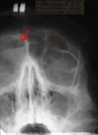 Рентген снимок заболевания