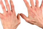 Аллергический дерматит на руках