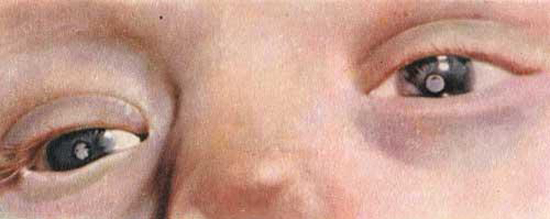 врожденная краснуха - катракта глаз
