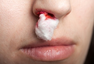 Что делать при кровотечении из носа
