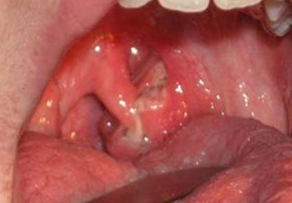 Фото горла - симптомы лакунарной ангины