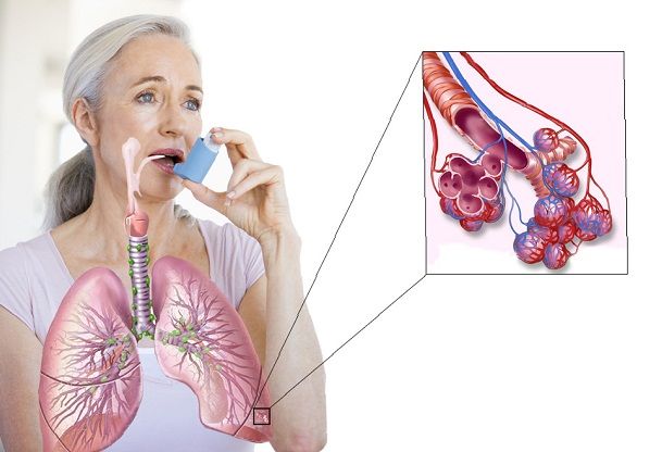 Осложнения при бронхиальной астме
