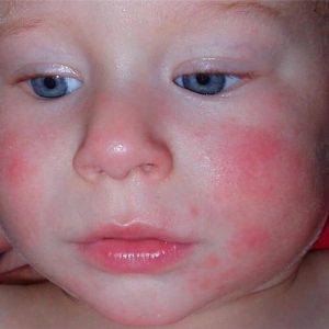 lechenie-dermatita-u-detei