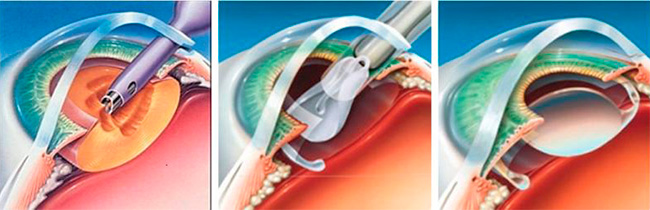 Операция по удалению катаракты