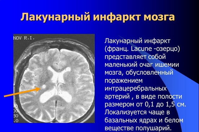 Поражения мозга на МРТ