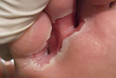 фото микоза кожи стопы между пальцами ног