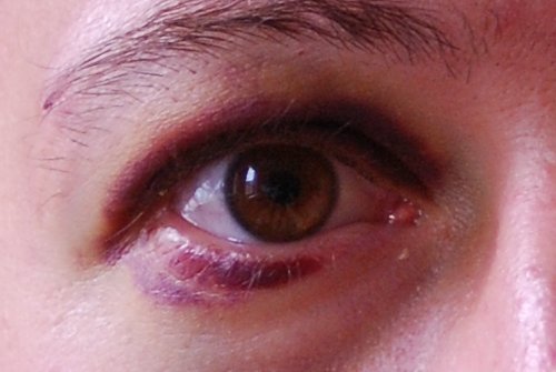 Ушиб глаза: симптомы и лечение
