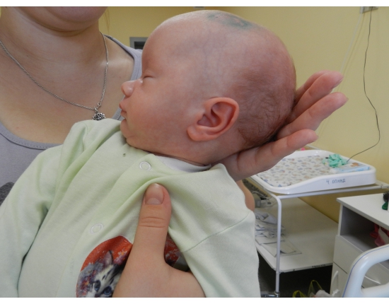 лечению водянки головного мозга у новорожденных