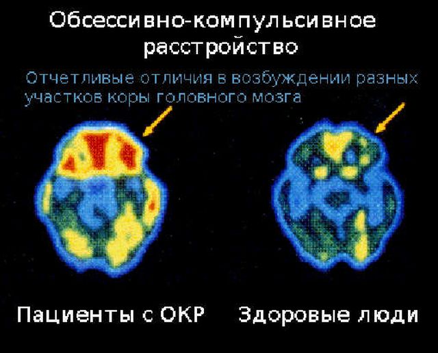 Мозг человека с ОКР