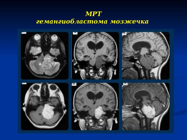 Опухоль мозжечка на МРТ