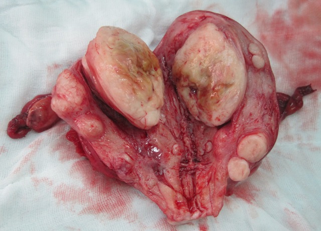 multiple-uterine-fibroids