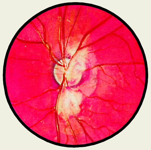 Ревматический ретиноваскулит