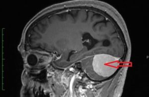 магниторезонансная томография мозга