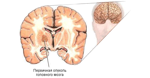 opuhol-mozga