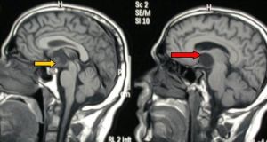 краниофарингиома головного мозга на мрт