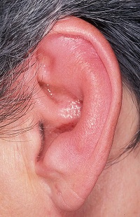 Внешний вид уха при наружном отите