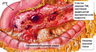 Железа при панкреонекрозе