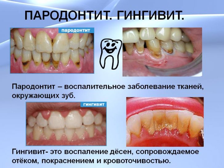 parodontit-giginvit-min