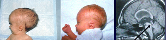 гидроцефалия у ребенка (фото)