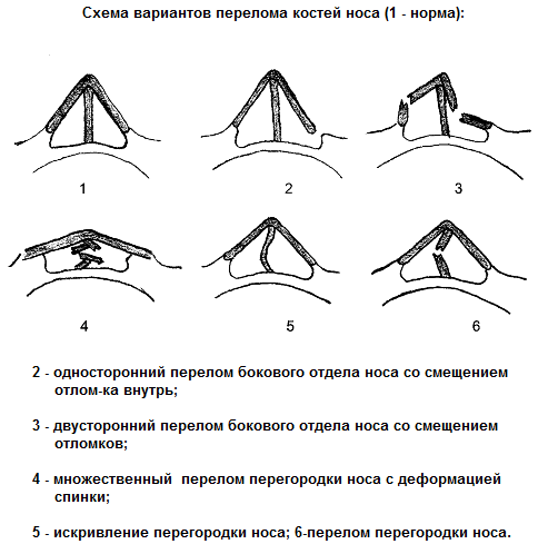 Разновидности перелома носа