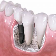 Очень часто существуют случаи, когда пациентам проделывают имплантацию зуба или протезирование