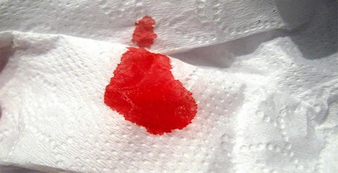 Лечение кровоточащего геморроя