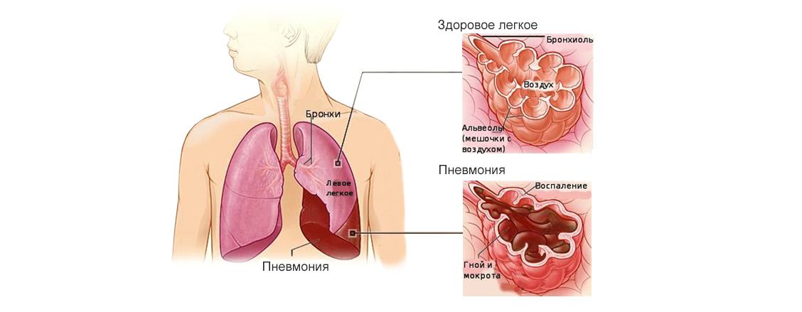 развития вирусной пневмонии