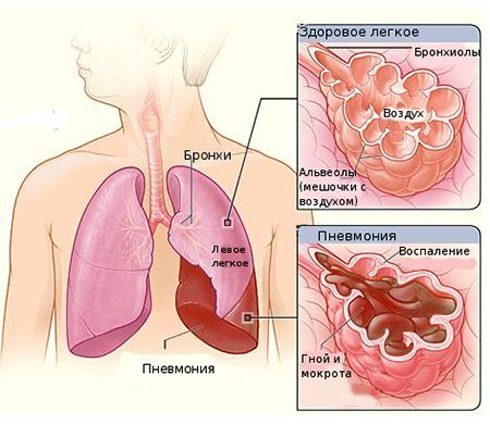 пневмония как осложнение при бронхите