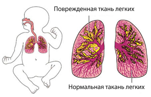 Схематическое изображение пневмонии (воспаления легких).