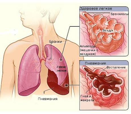 Схема пневмонии (воспаления легких).