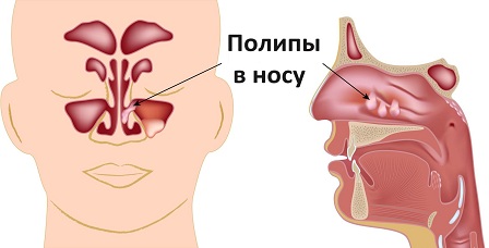 Расположение полипов в носу