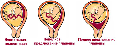 polojenie-placenti-u-children.ru_