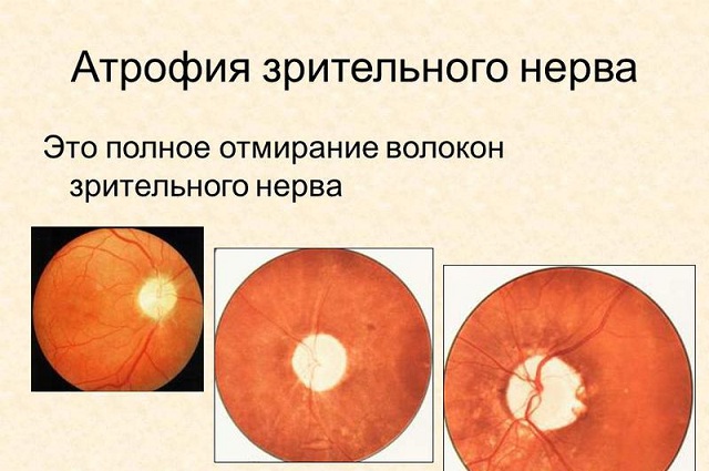 атрофия зрительного нерва
