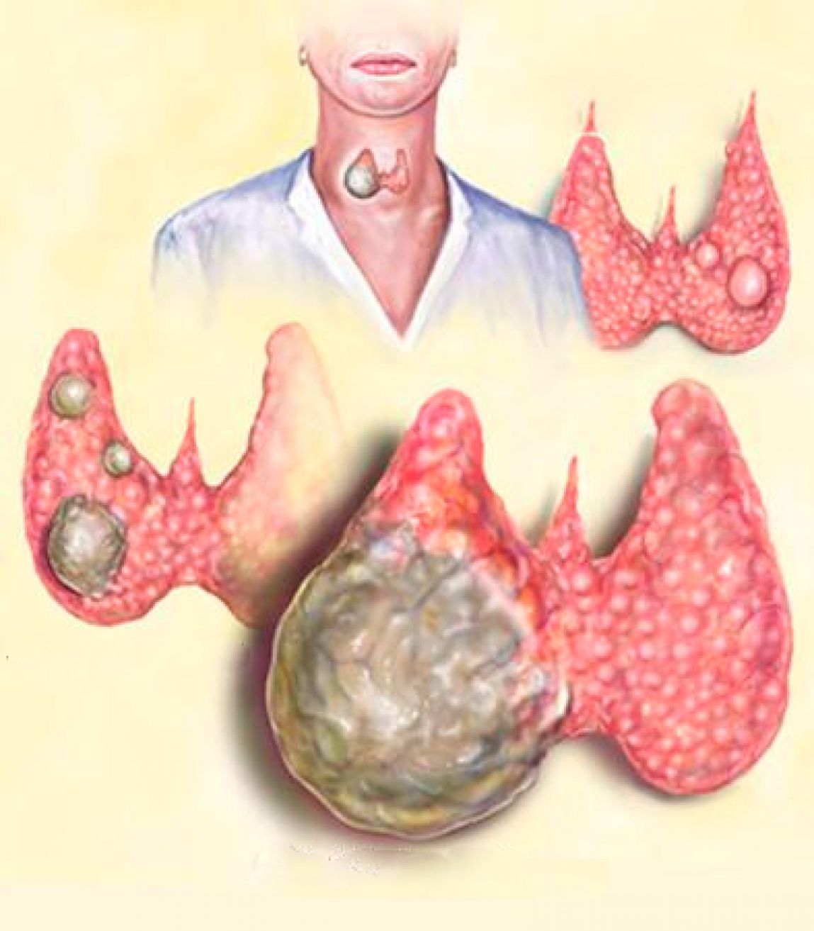 Разновидности кисты щитовидной железы