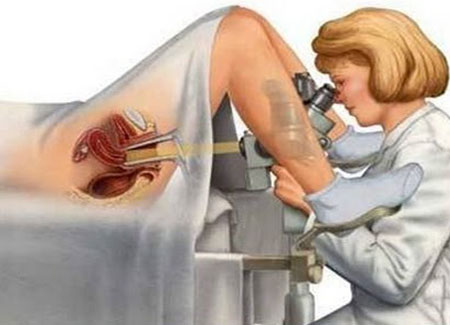 Техника проведения биопсии шейки матки