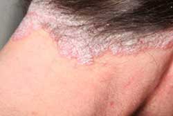 Симптомы псориаза волосистой части головы