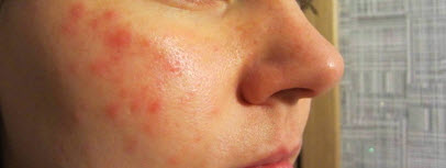 Лечение красных пятен на лице